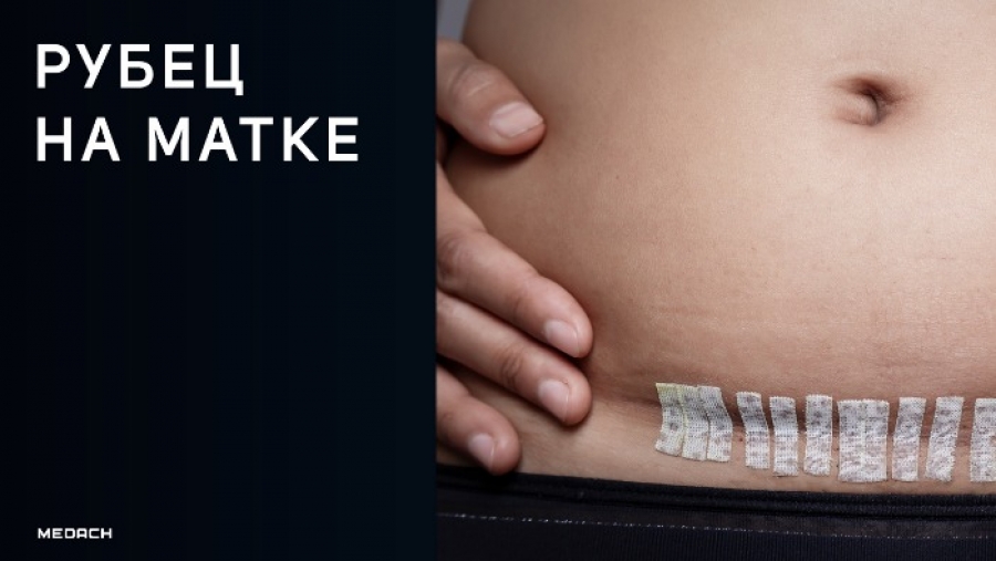 Рубец на матке после операции кесарева сечения: современные представления и тактика ведения беременности и родов